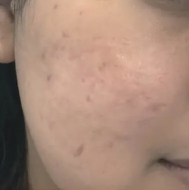 Pipi pengguna pada Day 1 dengan bekas jerawat dan kemerahan