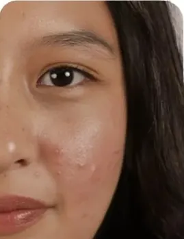 Shade Neutral: wajah dengan kemerahan dan bekas jerawat sebelum memakai cushion