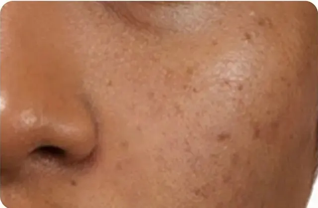 Kulit pipi dan hidung dari dekat