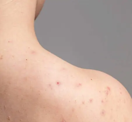 Bahu dan punggung atas berjerawat sebelum memakai Shower Oil